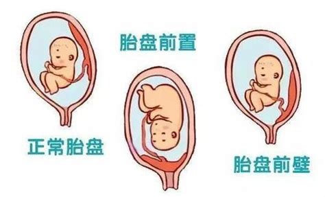 植入性胎盤症狀